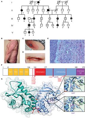 Novel TMEM173 Mutation and the Role of Disease Modifying Alleles